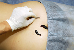 A gloved hand puts a leech on the back of a patient during a medical treatment. 
